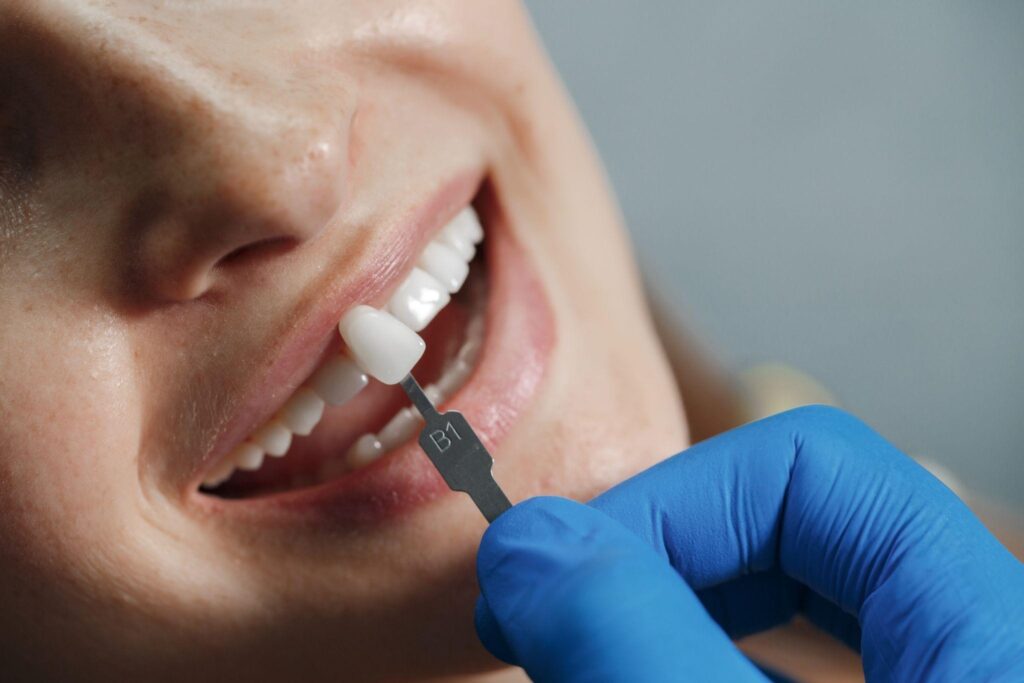 Ceramic Veneers: Transforming Smiles with Minimal Intervention